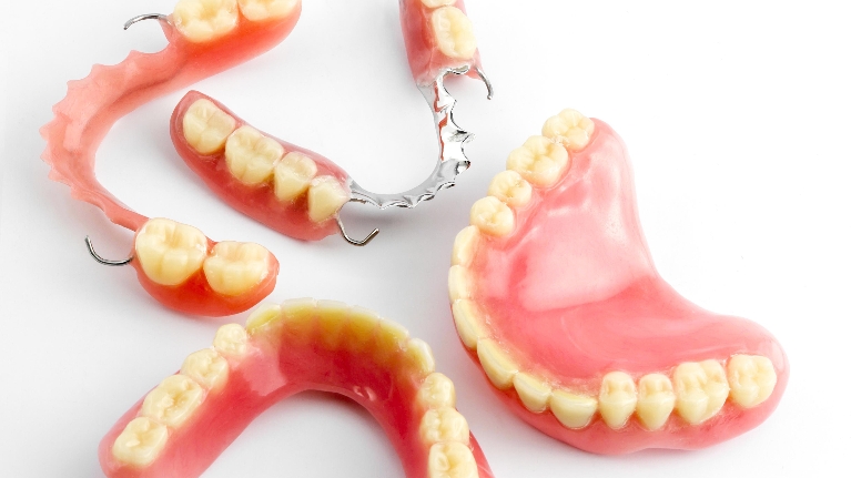 Composite fillings and veneers