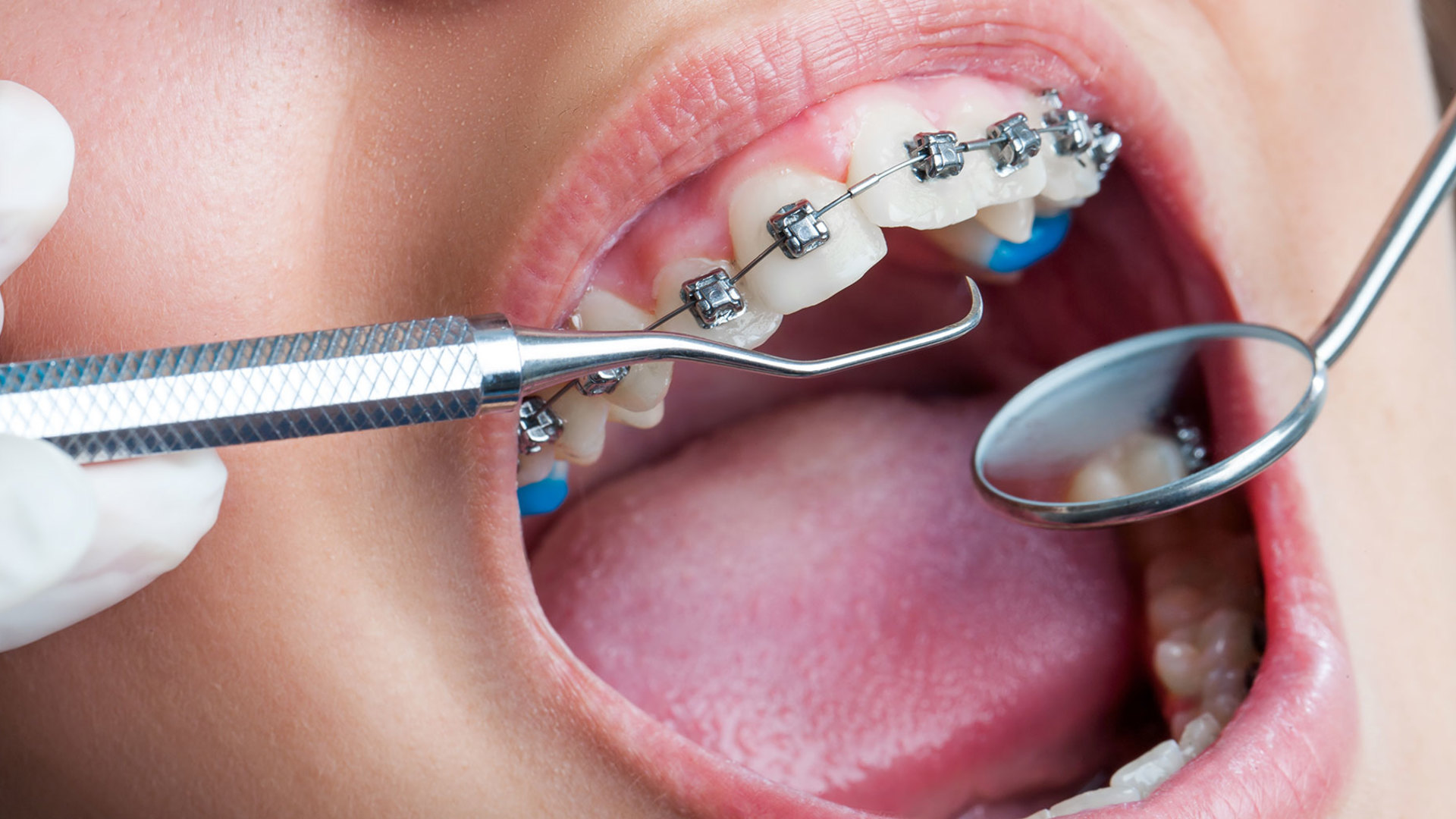 Orthodontics Dental Treatment