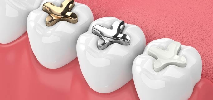 Teeth Whitening
