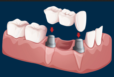Fixed Teeth Crown And Bridge In Gandhinagar