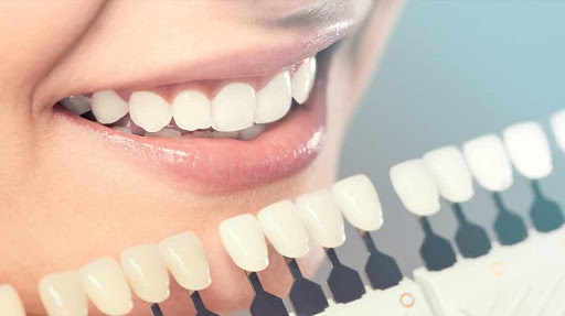 Composite fillings and veneers